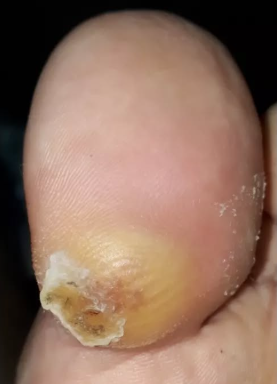 Antes del tratamiento de Callos